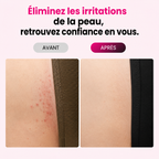 Nyvora™ Skin PRO – Photoépilateur IPL